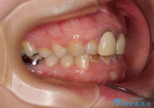 前歯のデコボコをワイヤー矯正で綺麗に 保険診療の前歯クラウンもセラミッククラウンで自然にの治療前