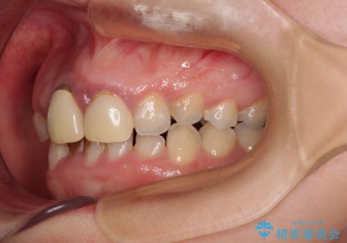 前歯のデコボコをワイヤー矯正で綺麗に 保険診療の前歯クラウンもセラミッククラウンで自然にの治療前