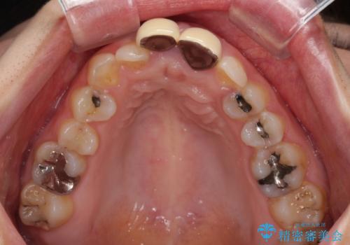 前歯のデコボコをワイヤー矯正で綺麗に 保険診療の前歯クラウンもセラミッククラウンで自然にの治療前