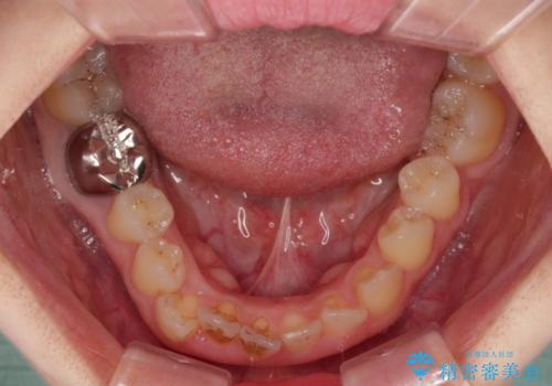 前歯のデコボコをワイヤー矯正で綺麗に 保険診療の前歯クラウンもセラミッククラウンで自然にの治療前
