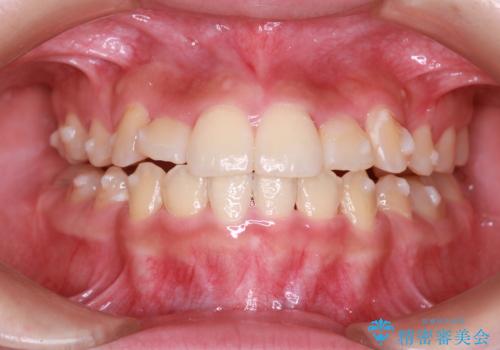 重度のガタガタを効率よく改善。ワイヤー矯正とインビザラインの併用治療の治療中