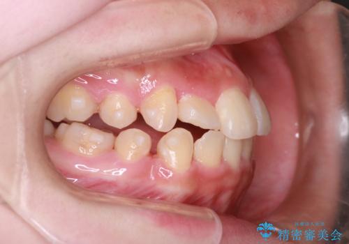 重度のガタガタを効率よく改善。ワイヤー矯正とインビザラインの併用治療の治療中