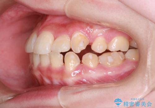 重度のガタガタを効率よく改善。ワイヤー矯正とインビザラインの併用治療の治療中