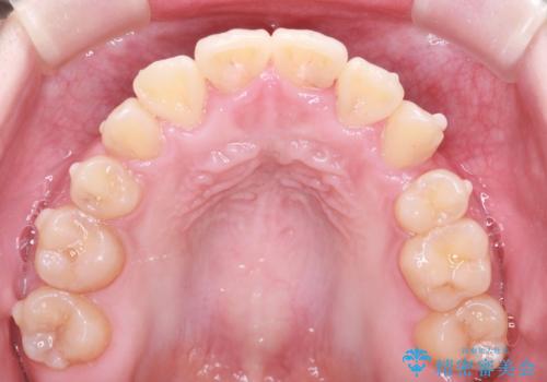 重度のガタガタを効率よく改善。ワイヤー矯正とインビザラインの併用治療の治療中
