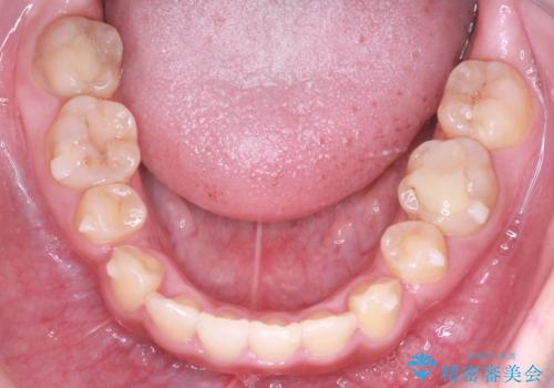 重度のガタガタを効率よく改善。ワイヤー矯正とインビザラインの併用治療の治療中