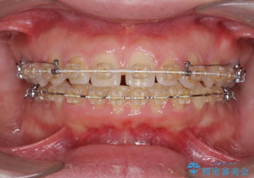 深い噛み合わせ、すきっ歯の改善 ワイヤーを用いたマルチブラケット矯正の治療中