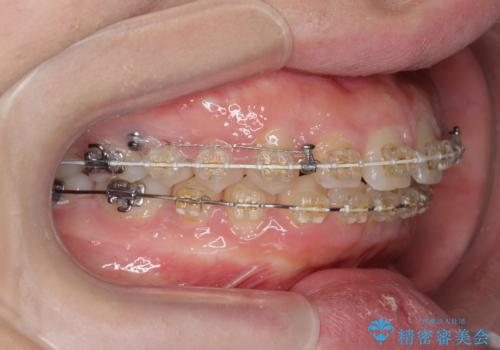 深い噛み合わせ、すきっ歯の改善 ワイヤーを用いたマルチブラケット矯正の治療中