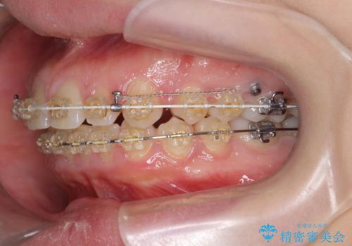 深い噛み合わせ、すきっ歯の改善 ワイヤーを用いたマルチブラケット矯正の治療中