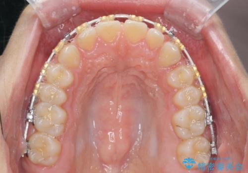 深い噛み合わせ、すきっ歯の改善　ワイヤーを用いたマルチブラケット矯正の治療中