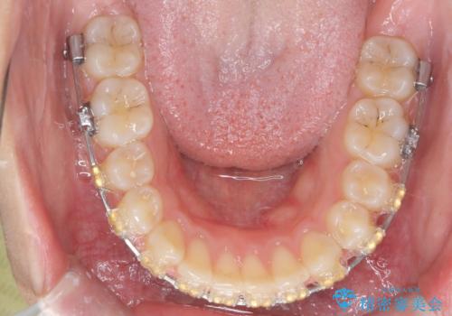 深い噛み合わせ、すきっ歯の改善　ワイヤーを用いたマルチブラケット矯正の治療中