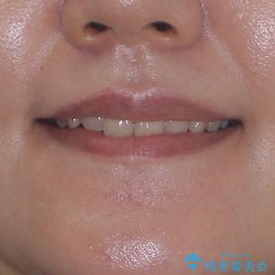 隠れた前歯が気になる ディープバイトのワイヤー矯正治療の治療前(顔貌)