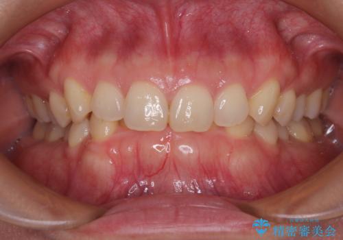 隠れた前歯が気になる　ディープバイトのワイヤー矯正治療