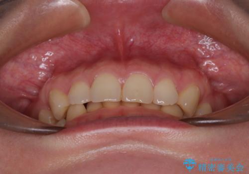 隠れた前歯が気になる　ディープバイトのワイヤー矯正治療の治療前