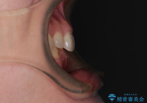 隠れた前歯が気になる ディープバイトのワイヤー矯正治療の治療前