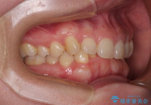 隠れた前歯が気になる　ディープバイトのワイヤー矯正治療の治療前