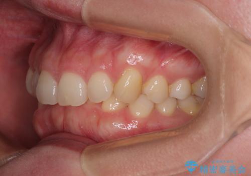 隠れた前歯が気になる　ディープバイトのワイヤー矯正治療の治療前