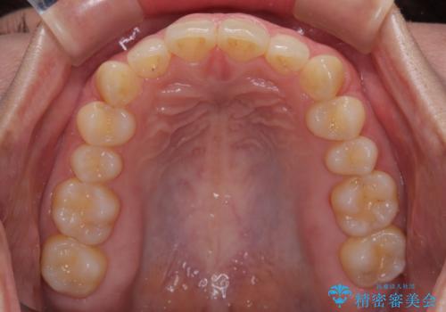 隠れた前歯が気になる　ディープバイトのワイヤー矯正治療の治療前