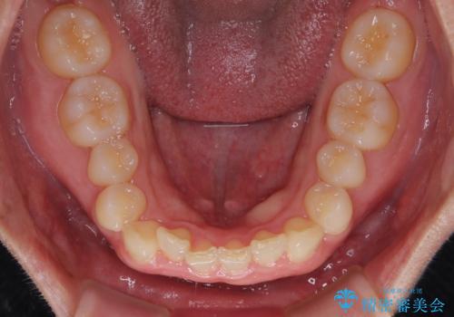 隠れた前歯が気になる　ディープバイトのワイヤー矯正治療の治療前