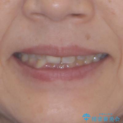 むし歯治療とインビザライン矯正治療 総合歯科治療で整った口腔内にの治療前(顔貌)