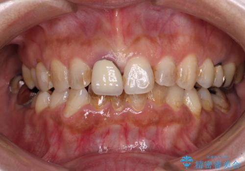 むし歯治療とインビザライン矯正治療 総合歯科治療で整った口腔内にの治療前