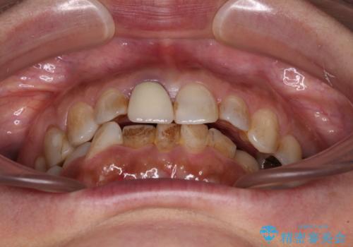 むし歯治療とインビザライン矯正治療 総合歯科治療で整った口腔内にの治療前