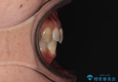 むし歯治療とインビザライン矯正治療 総合歯科治療で整った口腔内にの治療前