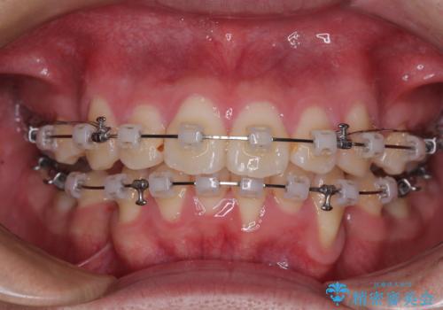 全体的なデコボコをスッキリと ワイヤー装置での抜歯矯正の治療中