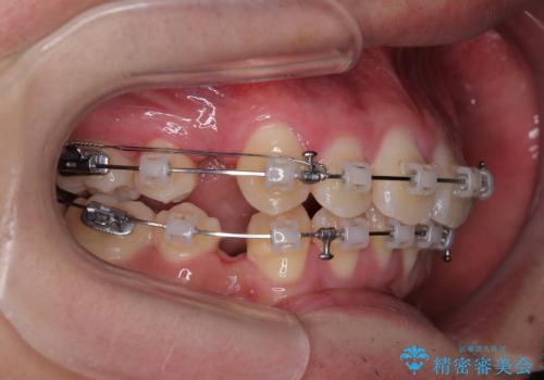 全体的なデコボコをスッキリと　ワイヤー装置での抜歯矯正の治療中