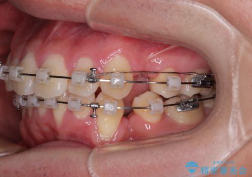 全体的なデコボコをスッキリと ワイヤー装置での抜歯矯正の治療中