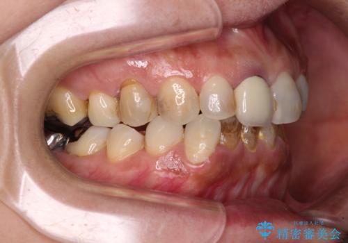 むし歯治療とインビザライン矯正治療 総合歯科治療で整った口腔内にの治療前