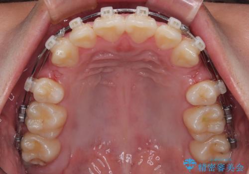 全体的なデコボコをスッキリと　ワイヤー装置での抜歯矯正の治療中