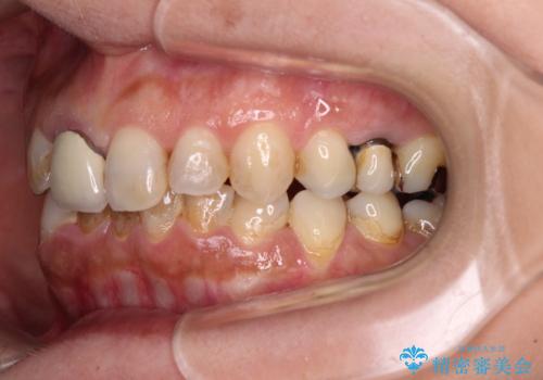 むし歯治療とインビザライン矯正治療 総合歯科治療で整った口腔内にの治療前