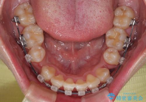 全体的なデコボコをスッキリと ワイヤー装置での抜歯矯正の治療中