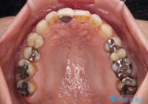 むし歯治療とインビザライン矯正治療 総合歯科治療で整った口腔内にの治療前