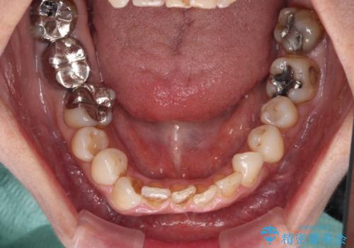 むし歯治療とインビザライン矯正治療 総合歯科治療で整った口腔内にの治療前