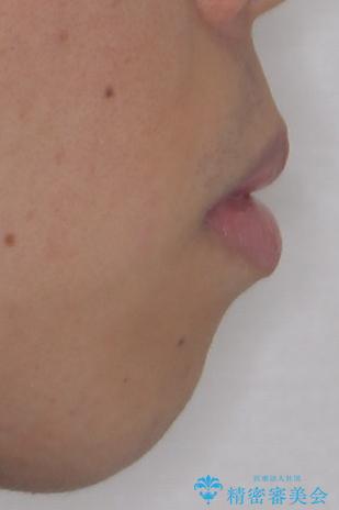 口が閉じにくい原因を根本から改善|上下顎4本抜歯による矯正治療症例の治療前(顔貌)