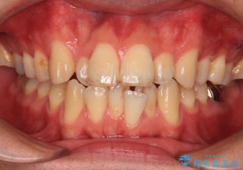 口が閉じにくい原因を根本から改善|上下顎4本抜歯による矯正治療症例
