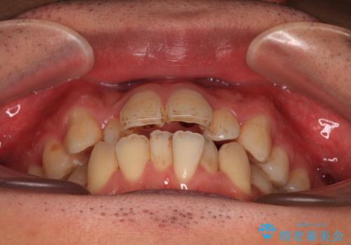 口が閉じにくい原因を根本から改善|上下顎4本抜歯による矯正治療症例の治療前