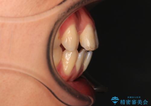 口が閉じにくい原因を根本から改善|上下顎4本抜歯による矯正治療症例の治療前