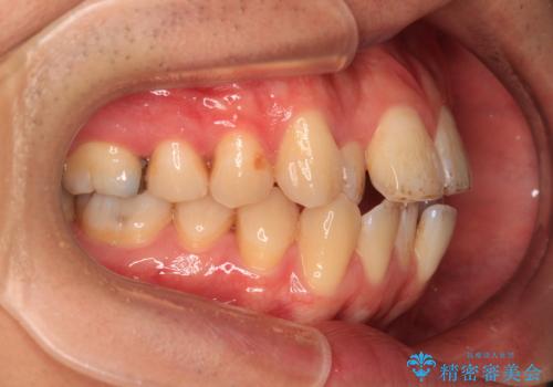 口が閉じにくい原因を根本から改善|上下顎4本抜歯による矯正治療症例の治療前