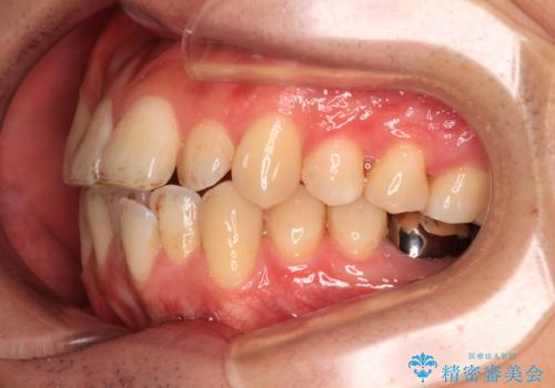 口が閉じにくい原因を根本から改善|上下顎4本抜歯による矯正治療症例の治療前