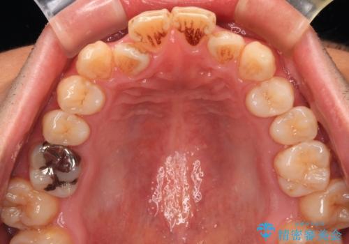 口が閉じにくい原因を根本から改善|上下顎4本抜歯による矯正治療症例の治療前