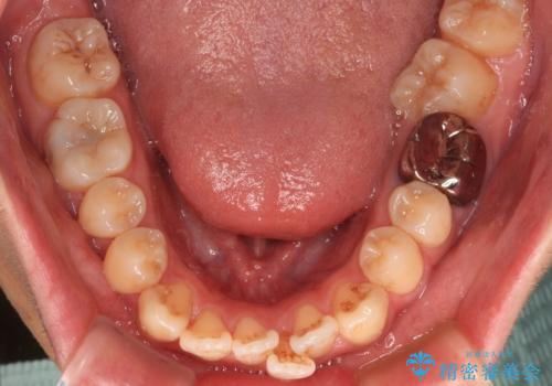 口が閉じにくい原因を根本から改善|上下顎4本抜歯による矯正治療症例の治療前