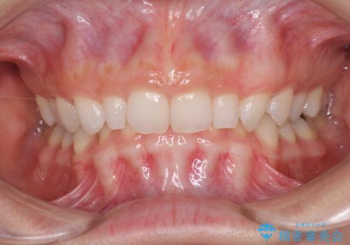 前歯のデコボコと小さい歯を改善　インビザラインとオールセラミッククラウンの症例 治療前