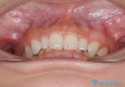 前歯のデコボコと小さい歯を改善 インビザラインとオールセラミッククラウンの治療前