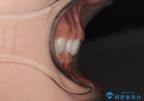 前歯のデコボコと小さい歯を改善　インビザラインとオールセラミッククラウンの治療前