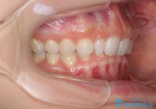 前歯のデコボコと小さい歯を改善　インビザラインとオールセラミッククラウンの治療前