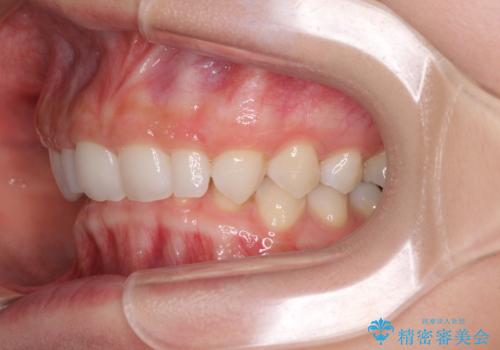 前歯のデコボコと小さい歯を改善　インビザラインとオールセラミッククラウンの治療前
