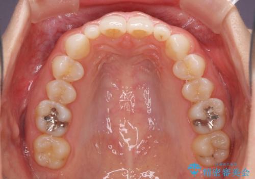 前歯のデコボコと小さい歯を改善　インビザラインとオールセラミッククラウンの治療前