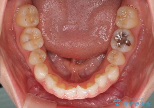 前歯のデコボコと小さい歯を改善　インビザラインとオールセラミッククラウンの治療前